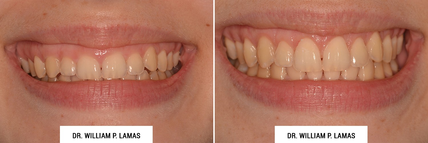 Crown Lengthening Before & After Photos - Dr. William Lamas
