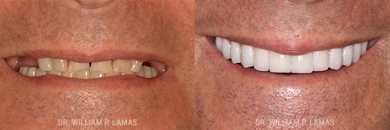 All-on-4 Dental Implants Before & After Photo - William P. Lamas, DMD - Periodontics & Dental Implants. 